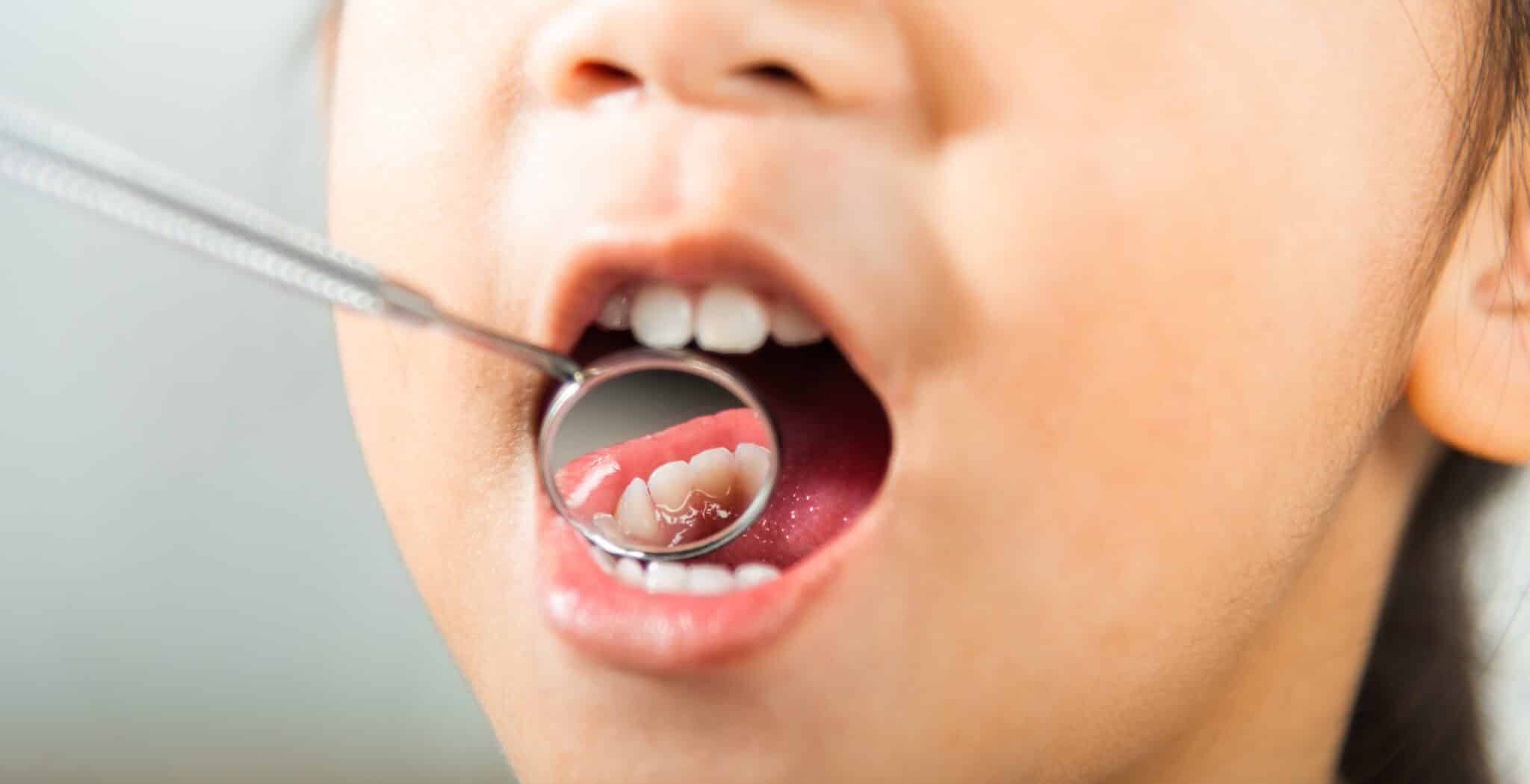 Lip and Tongue Tie Release in Rexburg