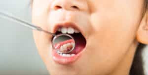Lip and Tongue Tie Release in Rexburg